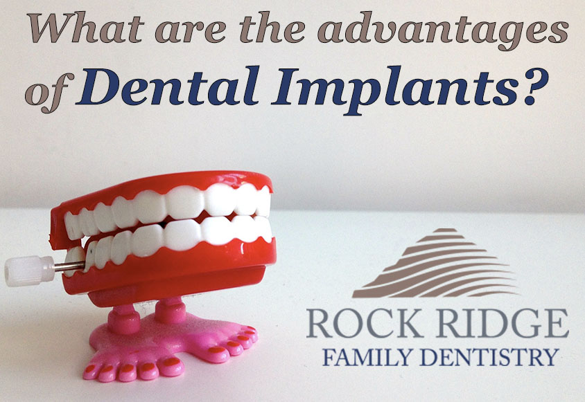 dental implants advantages