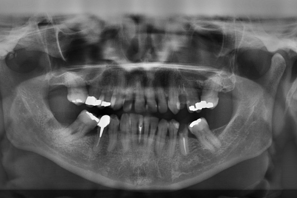 black and white dental x ray