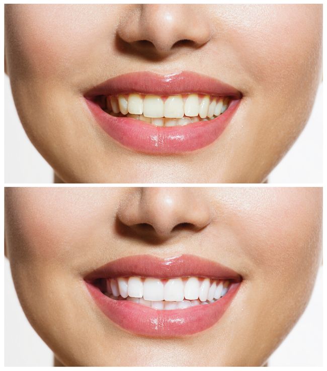 dental whitening round rock texas