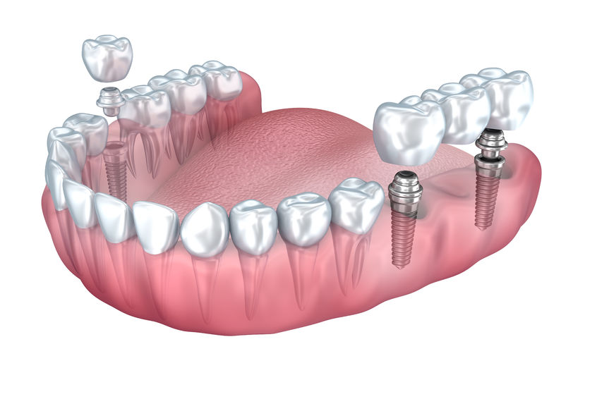 dental implants