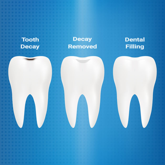 Composite VS Silver Fillings