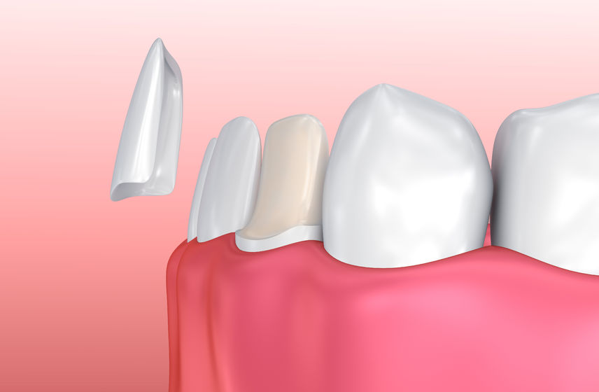 dental veneers round rock texas