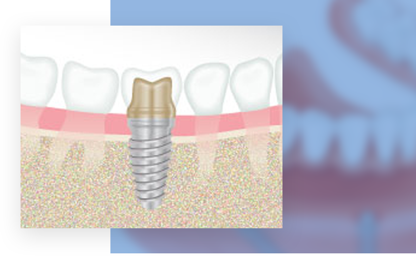 Dental Implants