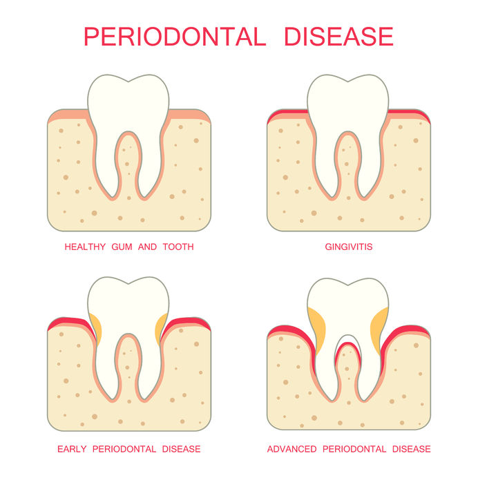 periodontal cleanings