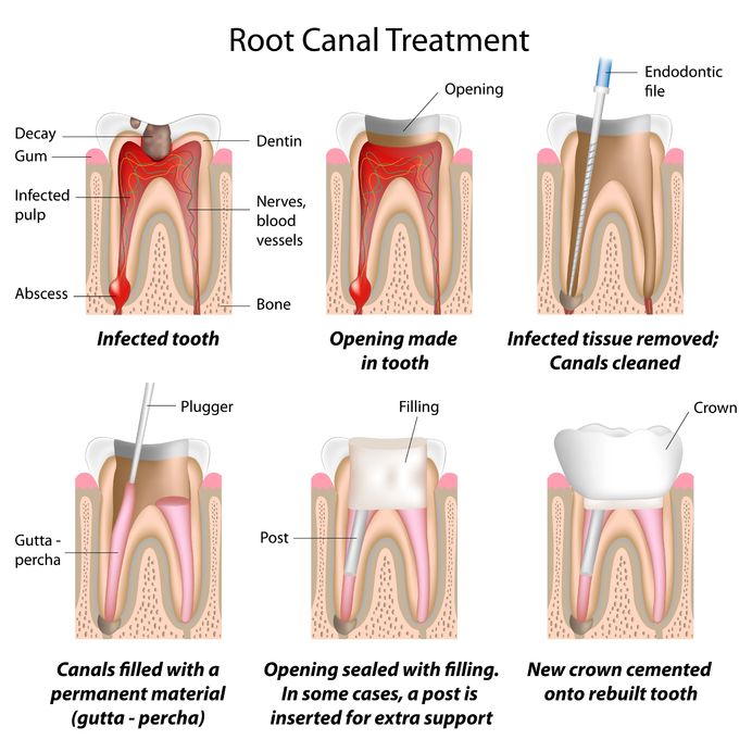 Root Canal Therapy in Round Rock TX