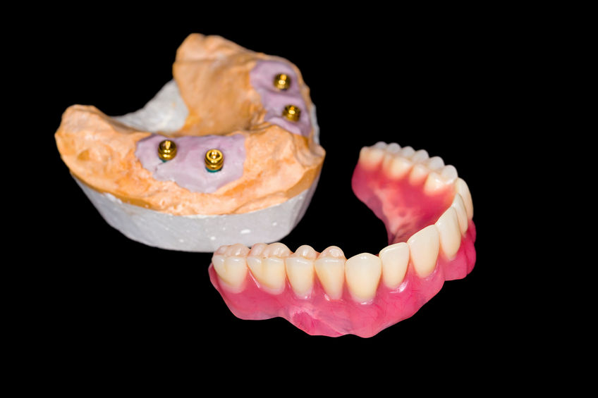 implant supported dentures round rock tx